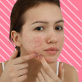 Natural Remedies for Acne: What You Need to Know